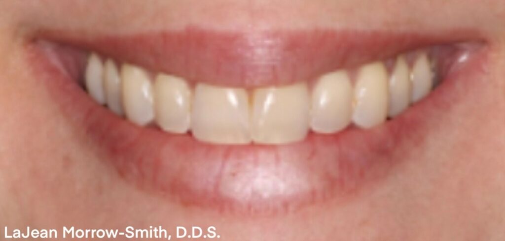E.max Veneer Cases: Achieving the Best Results