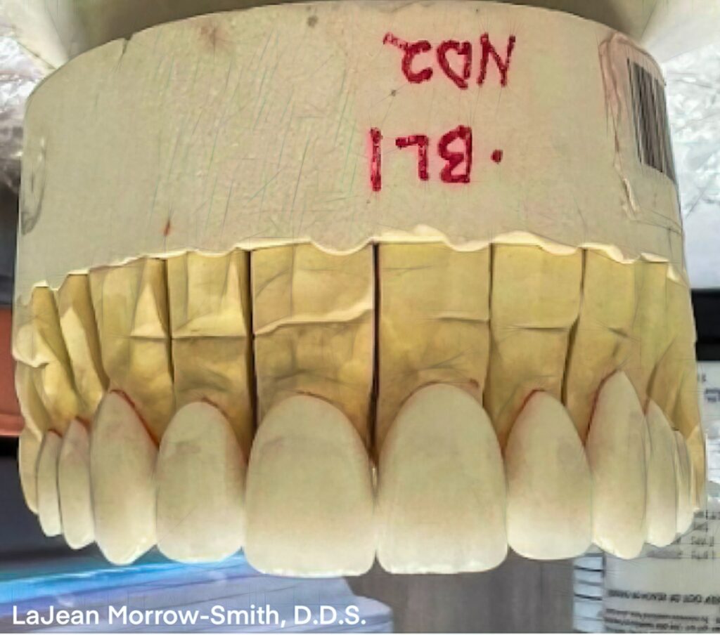 E.max Veneer Cases: Achieving the Best Results