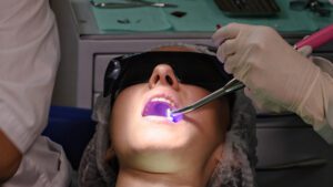 Indirect Composite: An Excellent Dental Restoration Option - Burbank Dental Lab - CA