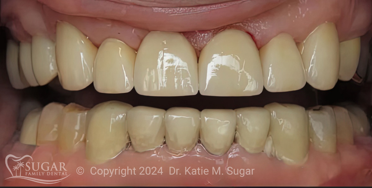 Optimized Treatment Planning: A Case Study with E.Max Restorations - Dr. Katie M. Sugar, DMD - Sugar Family Dental  |  Burbank Dental Lab