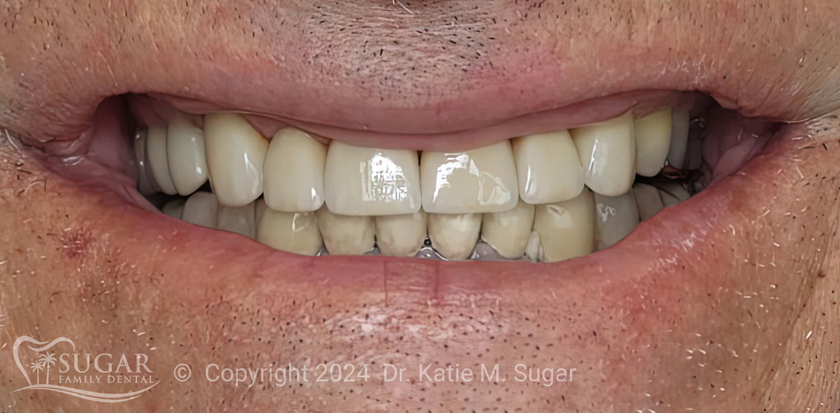 Optimized Treatment Planning: A Case Study with E.Max Restorations - Dr. Katie M. Sugar, DMD - Sugar Family Dental  |  Burbank Dental Lab