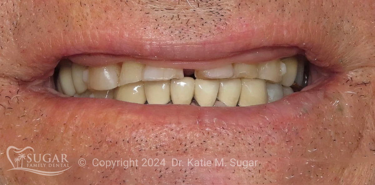 Optimized Treatment Planning: A Case Study with E.Max Restorations - Dr. Katie M. Sugar, DMD - Sugar Family Dental  |  Burbank Dental Lab