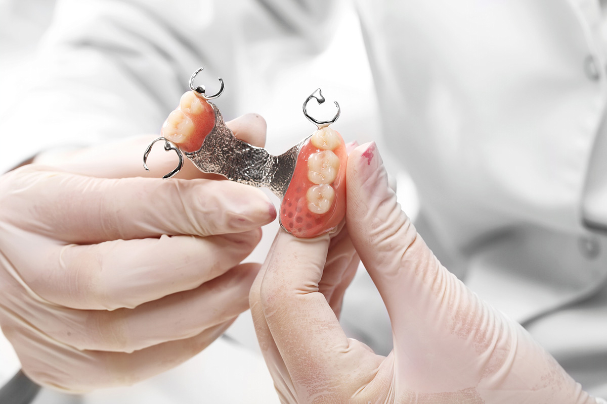 Implant-Assisted Removable Partial Dentures - Burbank Dental Lab - California Dental Lab