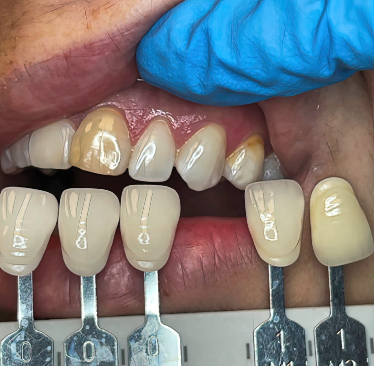 Mastering Dental Color Matching: Traditional vs. Technological Methods for Optimal Restorative Results - Burbank Dental Lab - California
