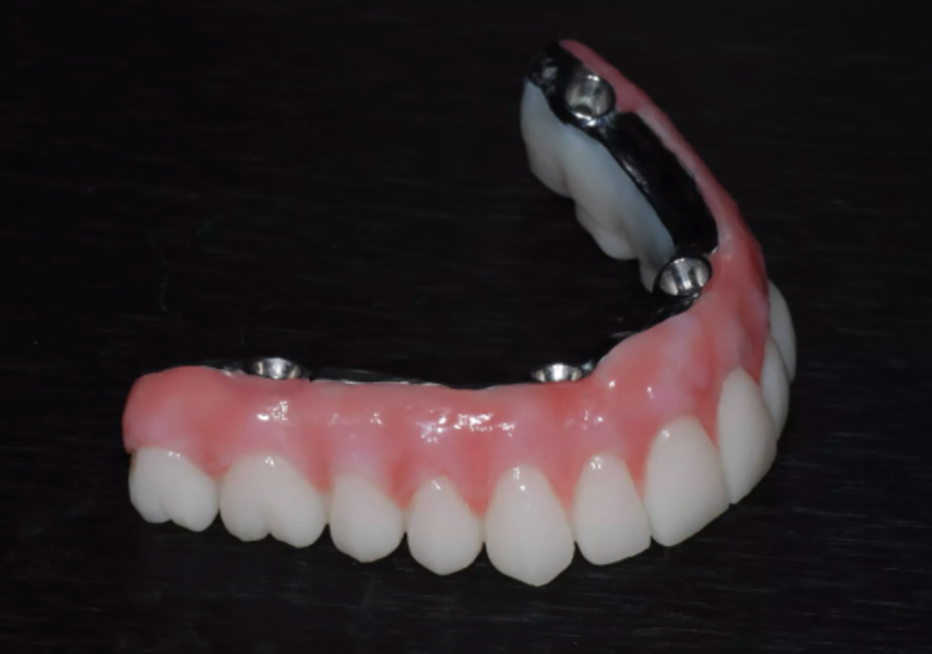 Elevating the Paradigm of Dental Restorations with SmartComposite Hybrids - Burbank Dental Lab