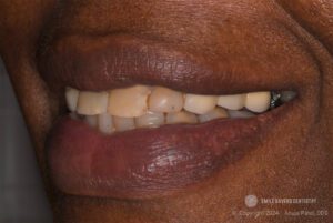 Zirconia Restorations in Dentistry - Case Study - Dr. Anuja Patel, DDS - Smile Savers Dentistry