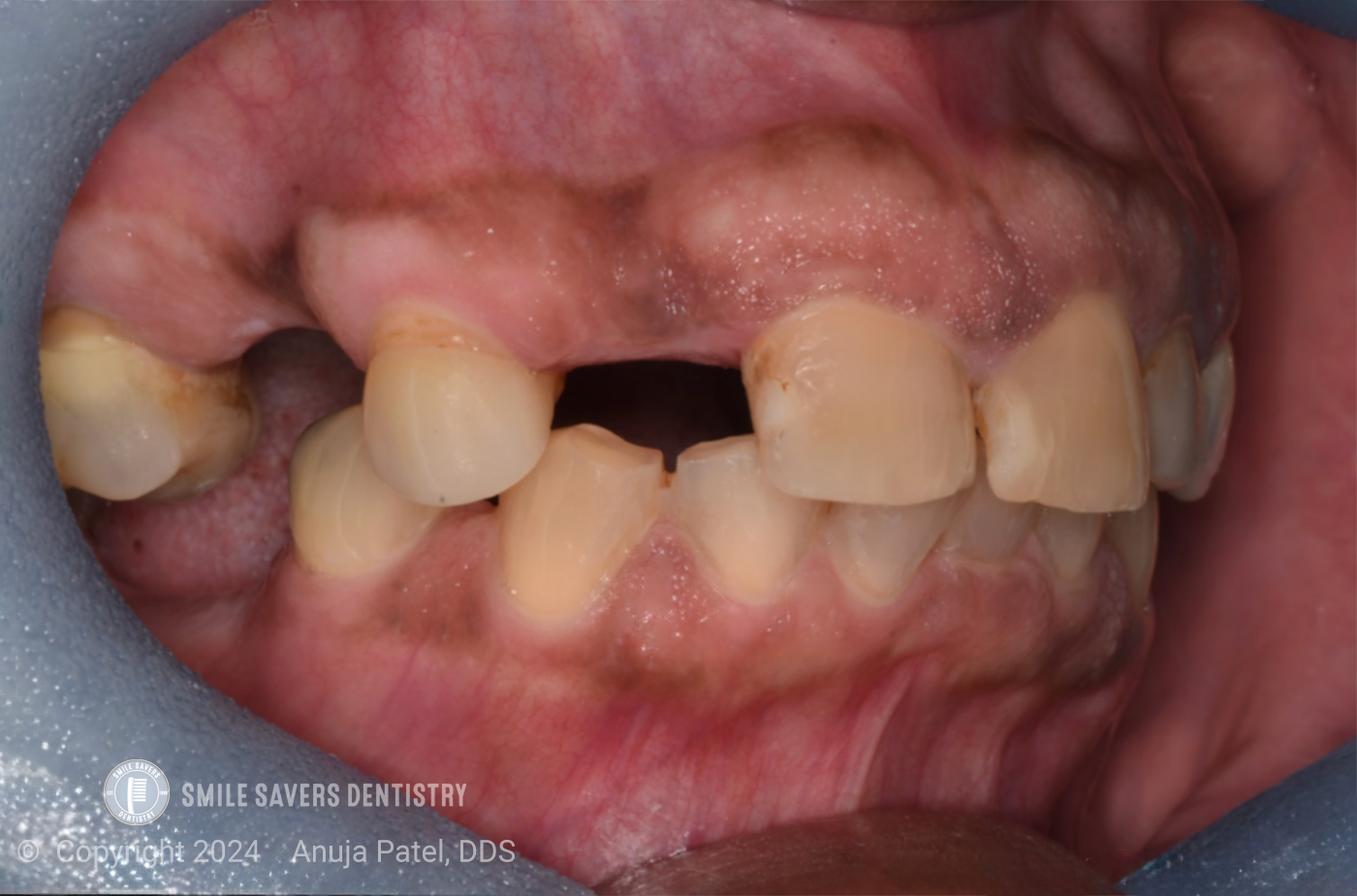 Zirconia Restorations in Dentistry - Case Study - Dr. Anuja Patel, DDS - Smile Savers Dentistry