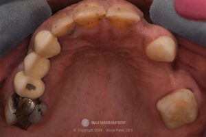 Zirconia Restorations in Dentistry - Case Study - Dr. Anuja Patel, DDS - Smile Savers Dentistry