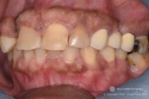 Zirconia Restorations in Dentistry - Case Study - Dr. Anuja Patel, DDS - Smile Savers Dentistry