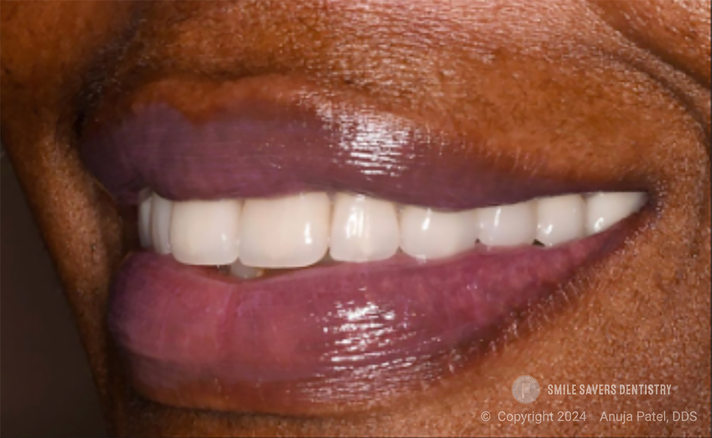 Zirconia Restorations in Dentistry - Case Study - Dr. Anuja Patel, DDS - Smile Savers Dentistry