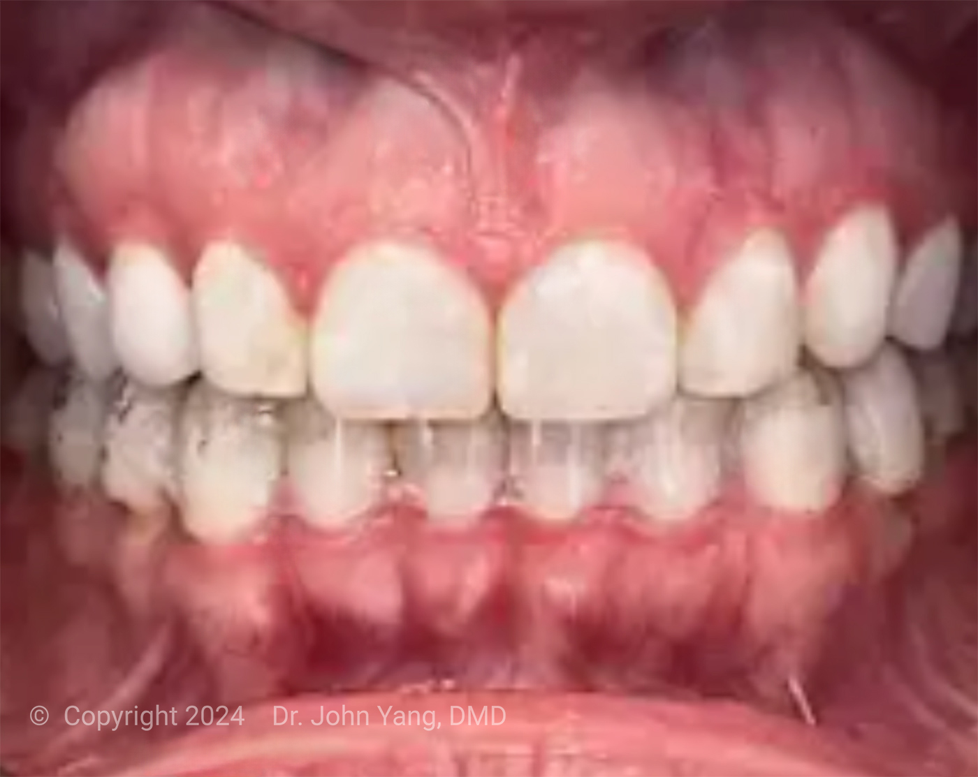 Smile Transformation - Dr. John Yang - Tru Family Dental and Burbank Dental Lab - California