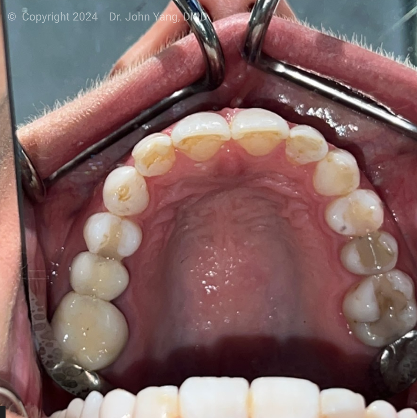 Smile Transformation - Dr. John Yang - Tru Family Dental and Burbank Dental Lab - California