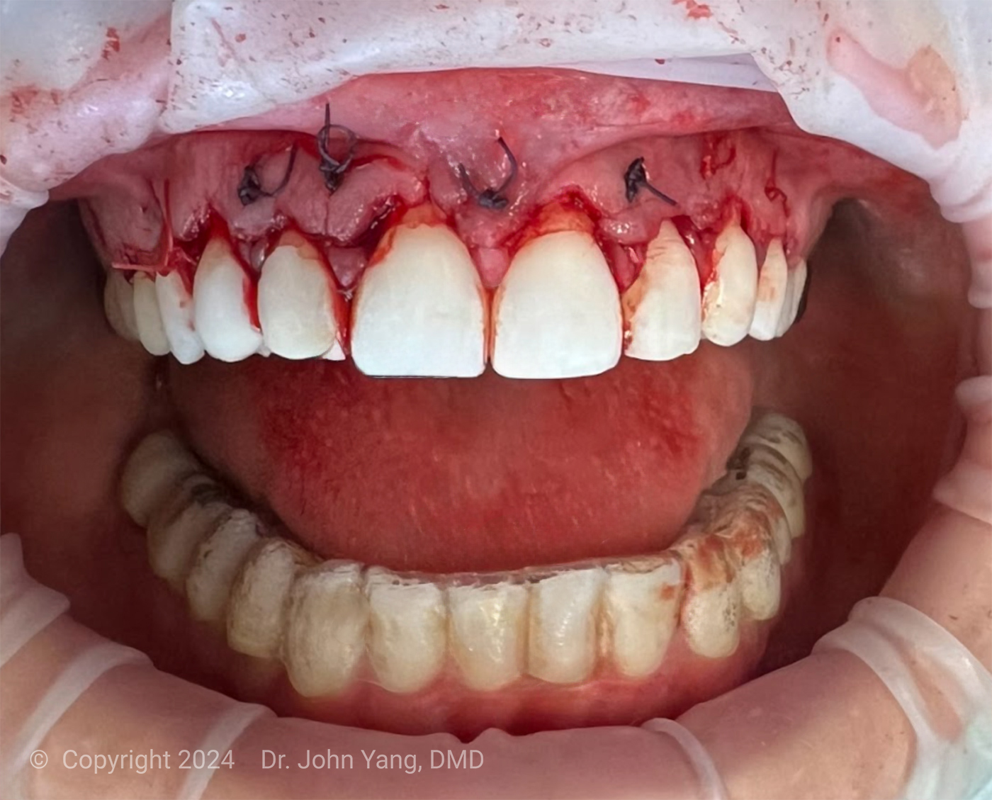 Smile Transformation - Dr. John Yang - Tru Family Dental and Burbank Dental Lab - California