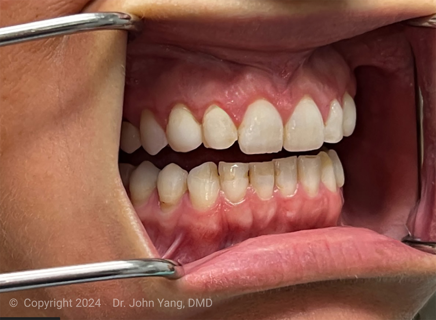 Smile Transformation - Dr. John Yang - Tru Family Dental and Burbank Dental Lab - California