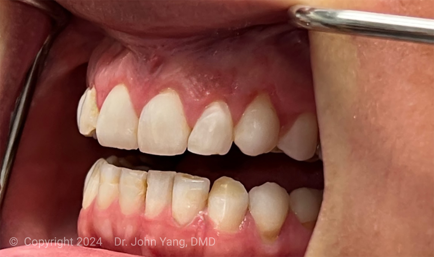 Smile Transformation - Dr. John Yang - Tru Family Dental and Burbank Dental Lab - California