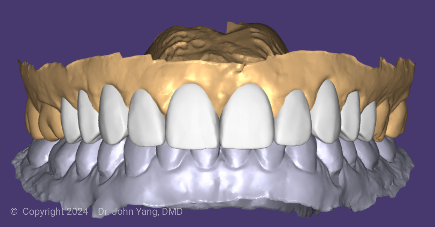 Smile Transformation - Dr. John Yang - Tru Family Dental and Burbank Dental Lab - California