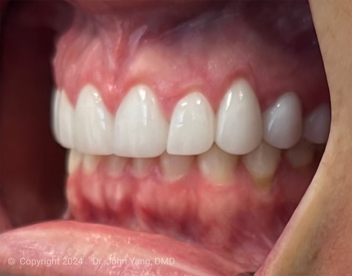 Smile Transformation - Dr. John Yang - Tru Family Dental and Burbank Dental Lab - California