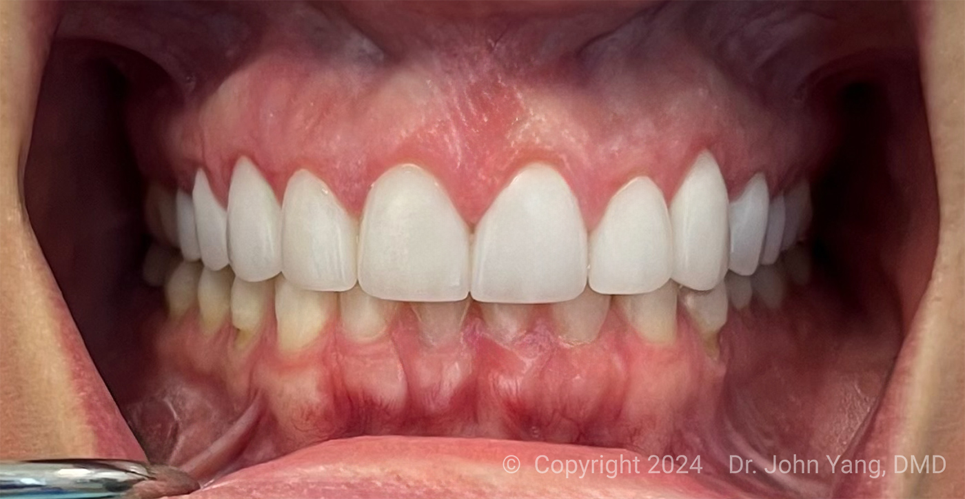 Smile Transformation - Dr. John Yang - Tru Family Dental and Burbank Dental Lab - California