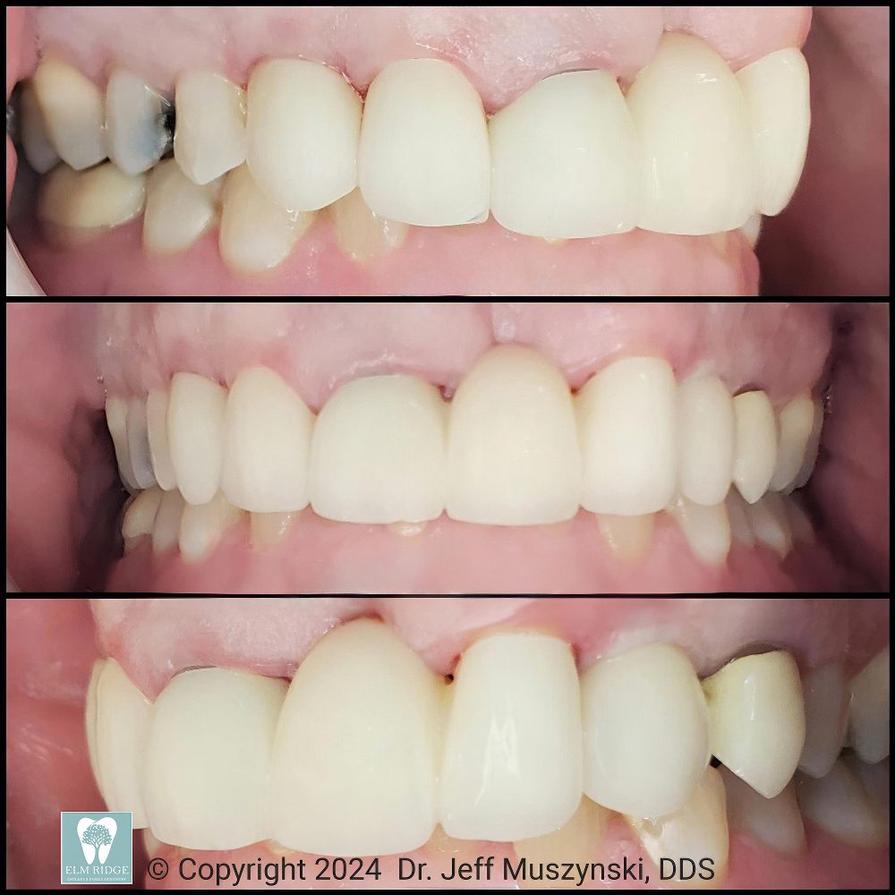 Treatment Planning for Complex Cases - Case Study with Dr. Jeff Muszynski, DDS - Elm Ridge Implant and Family Dentistry