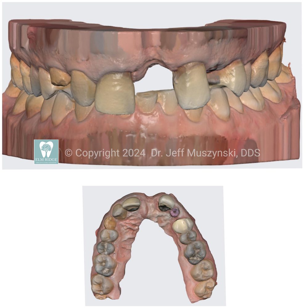 Treatment Planning for Complex Cases - Case Study with Dr. Jeff Muszynski, DDS - Elm Ridge Implant and Family Dentistry