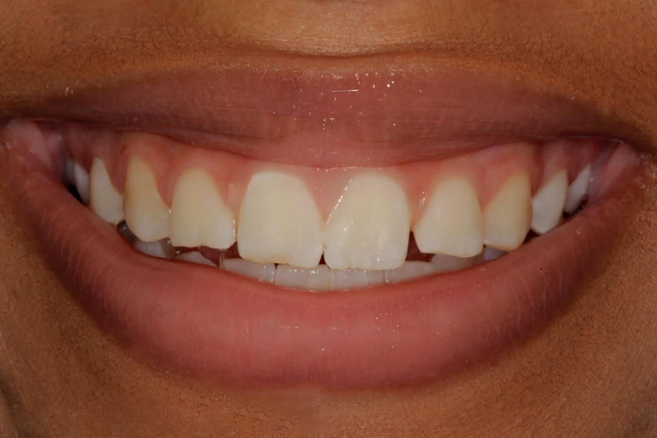 E.max Layered Veneers - BEFORE - Burbank Dental Lab, CA