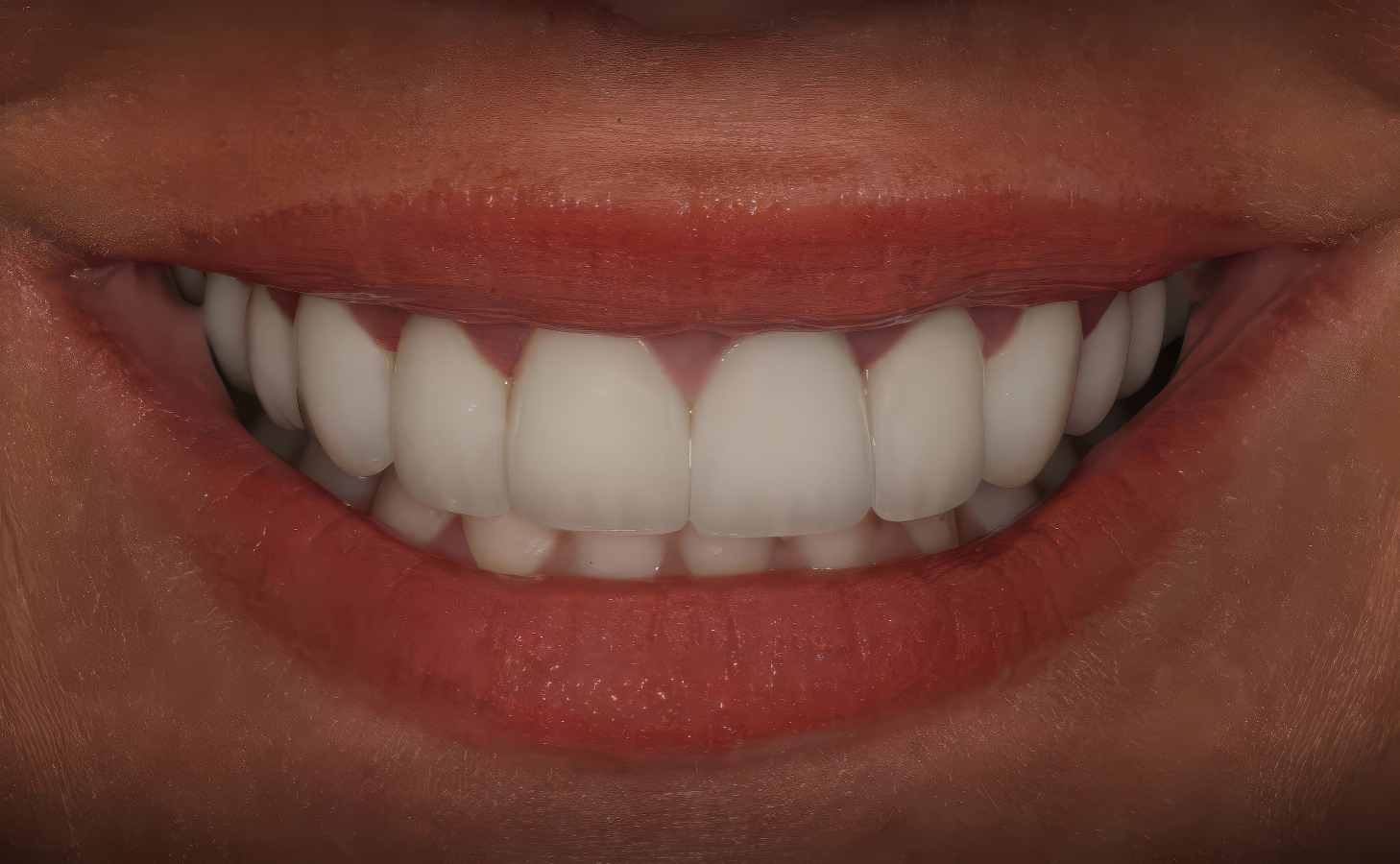 Feldspathic Porcelain Veneers - Burbank Dental Lab - CA