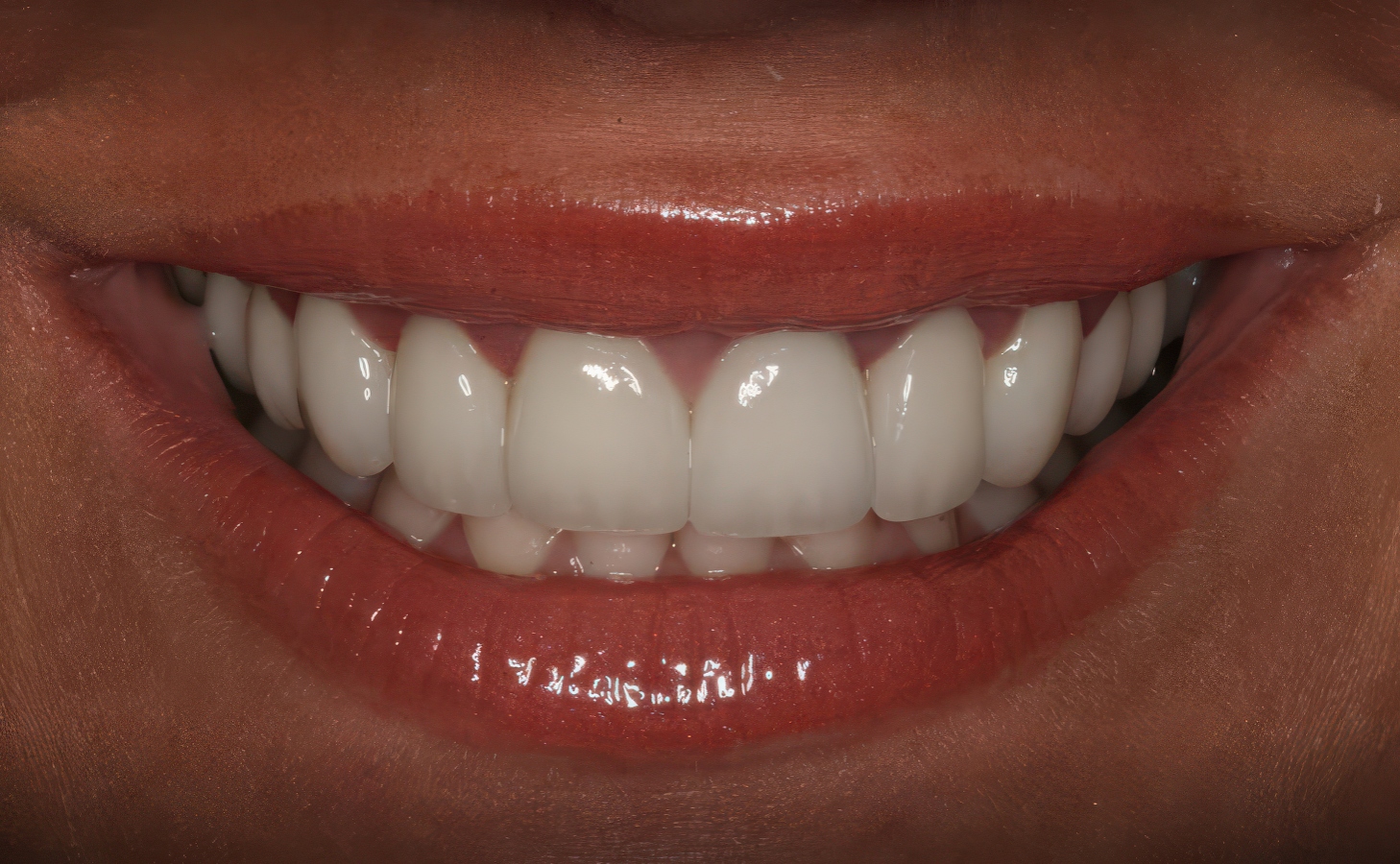 Classic Feldspathic Porcelain Veneers