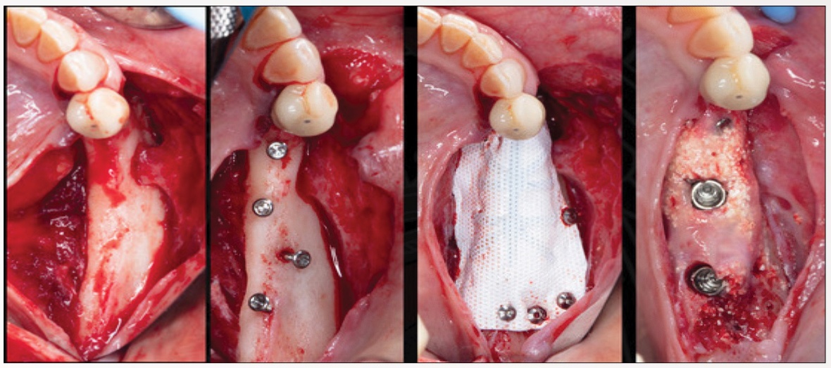 Bone & Tissue Regeneration Course - Sponsor - Burbank Dental Lab - CA