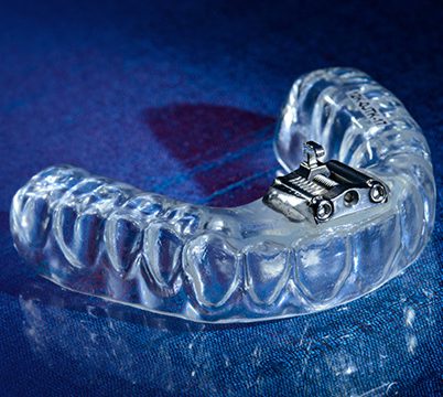 TAP 3 Appliance by Burbank Dental Lab