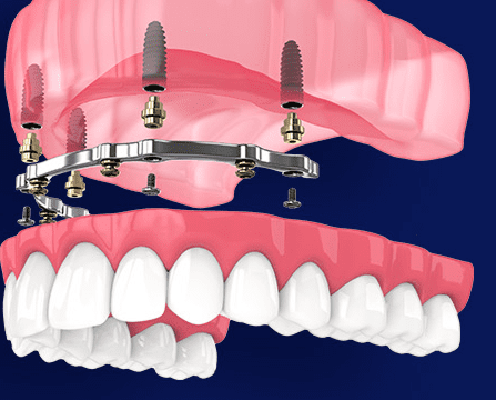 Multi-Unit Abutments: When and How To Use Them