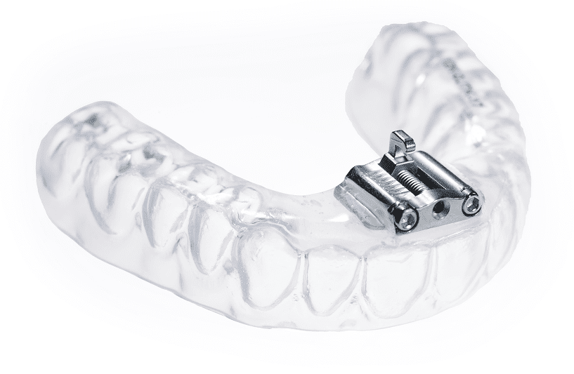 TAP 3 Appliance - Burbank Dental Lab