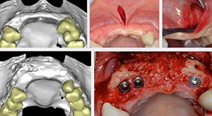 Advanced 3D GBR Guided Bone Regeneration Course - VISTA