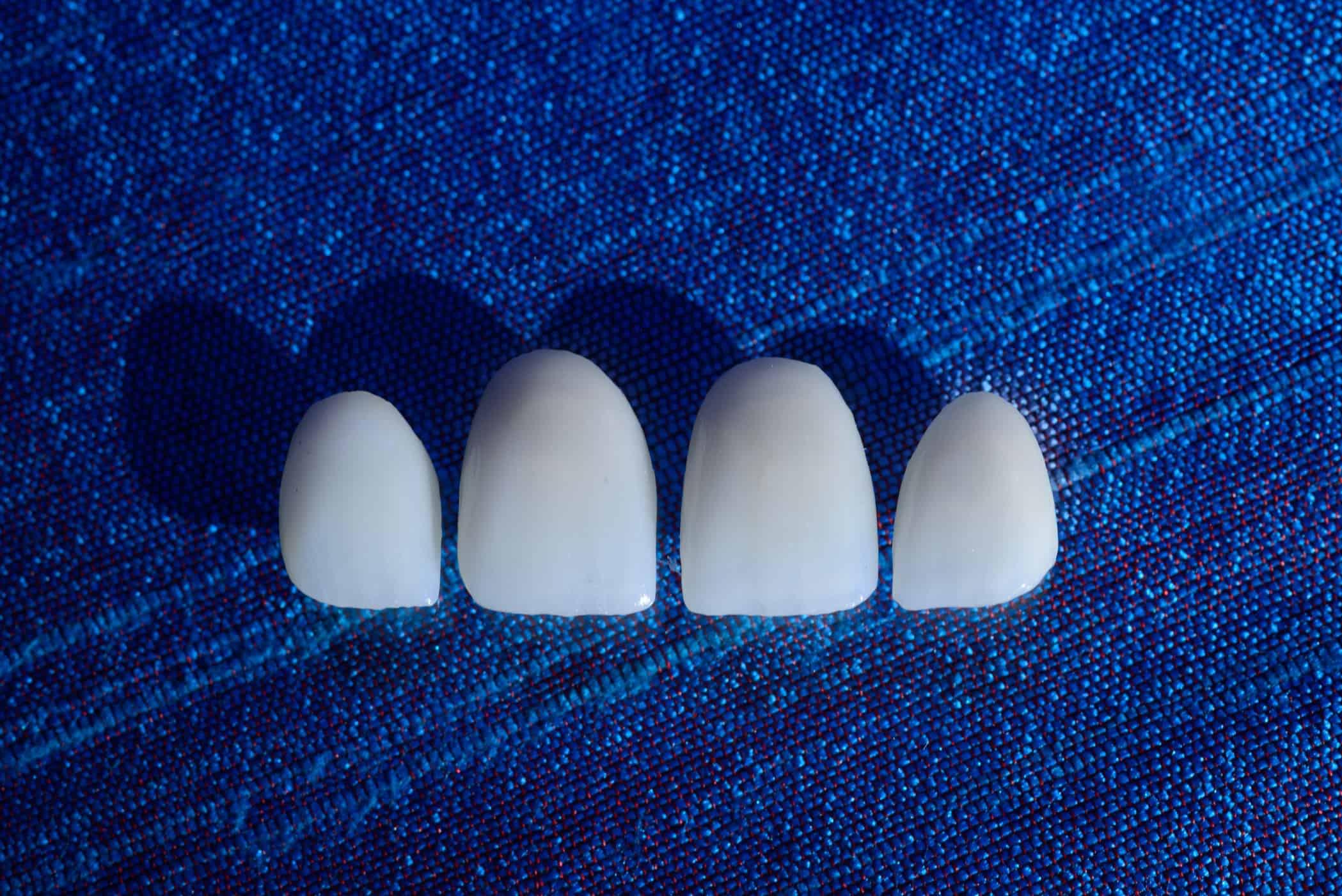 Porcelain veneers - shade communication