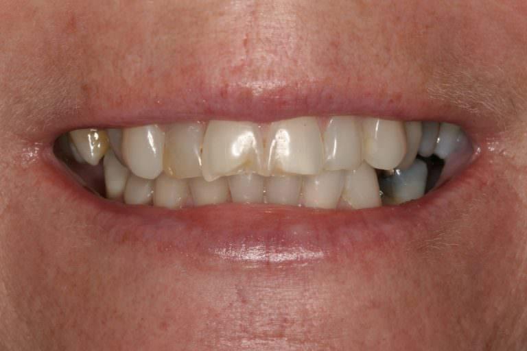 Burbank Dental Lab patient before full mouth rehabilitation