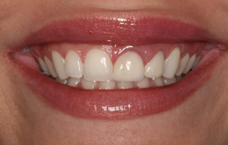 Burbank Dental Lab patient before e.max layered restoration