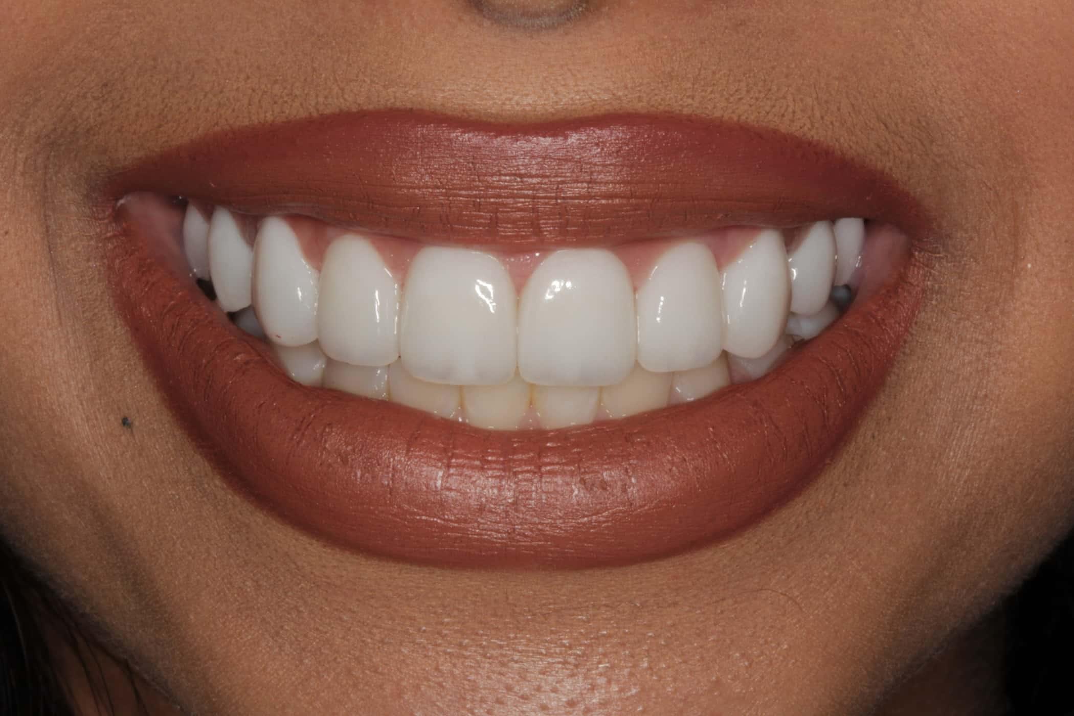 Patient of Burbank Dental lab with e.max veneers