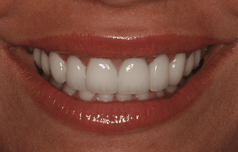 Burbank Dental Lab patient after e.max layered restorations