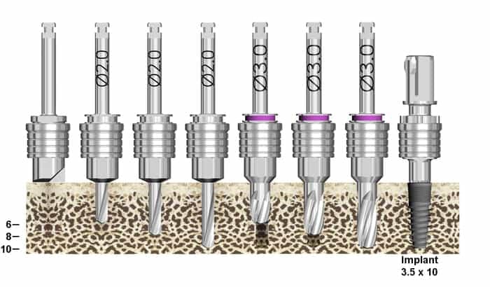 Burbank Dental Lab guided surgery kit