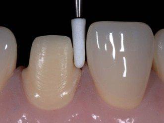 Burbank Dental Lab clinical handling and preparation for e.max