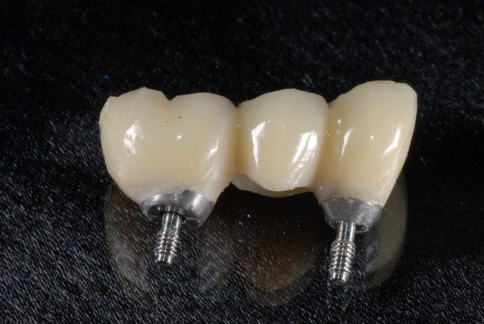 Burbank Dental Lab provisional