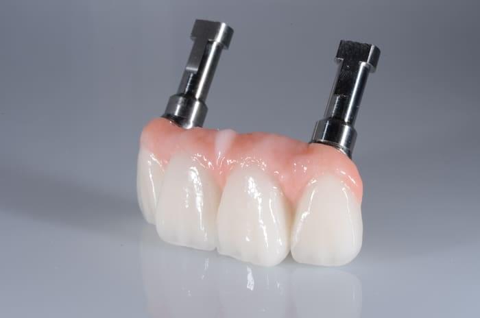 Burbank Dental Lab Smart 1® dental restoration