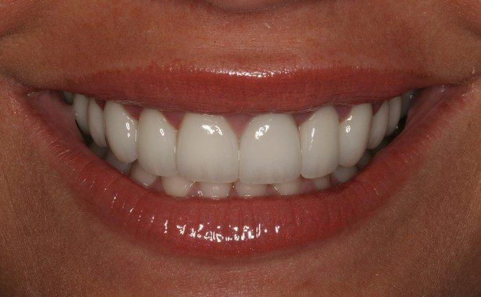 Burbank Dental Lab patient with IPS e.max restoration