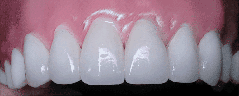 Burbank Dental Lab DuraTemps provisionals teeth