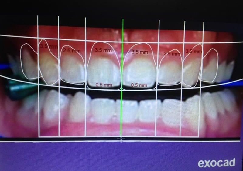 Digital smile silhouette for wax-up
