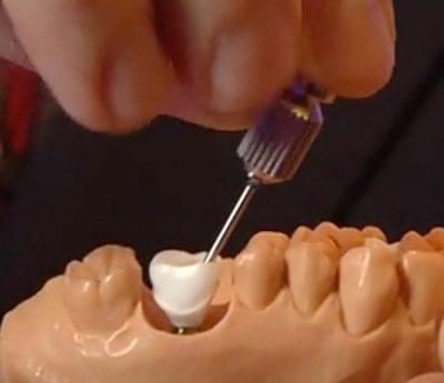Angled access to posterior restoration