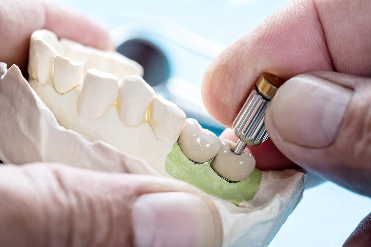 SMART 1 screw retained abutment CO/CR - Burbank Dental Lab