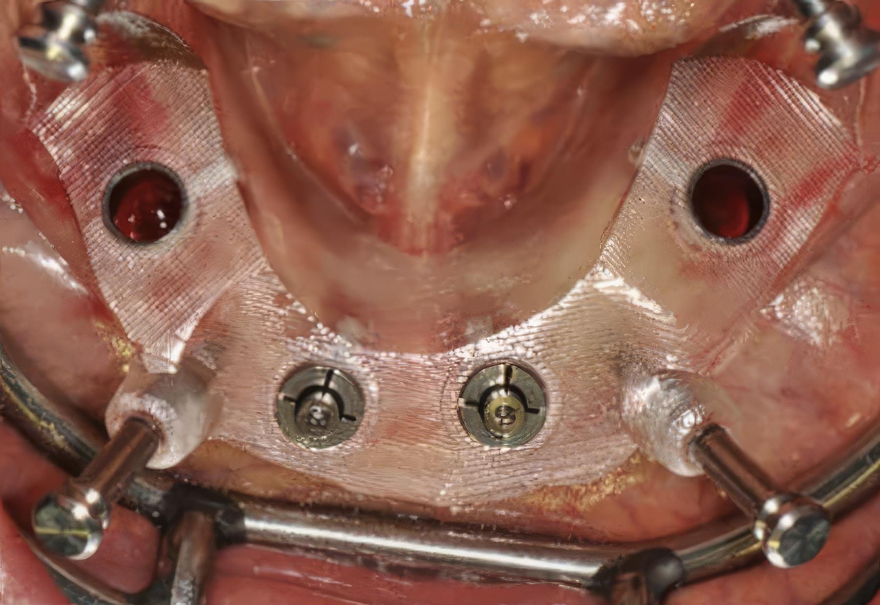 Step-By-Step Digital Workflow for Edentulous Implant Cases | Burbank Dental Lab