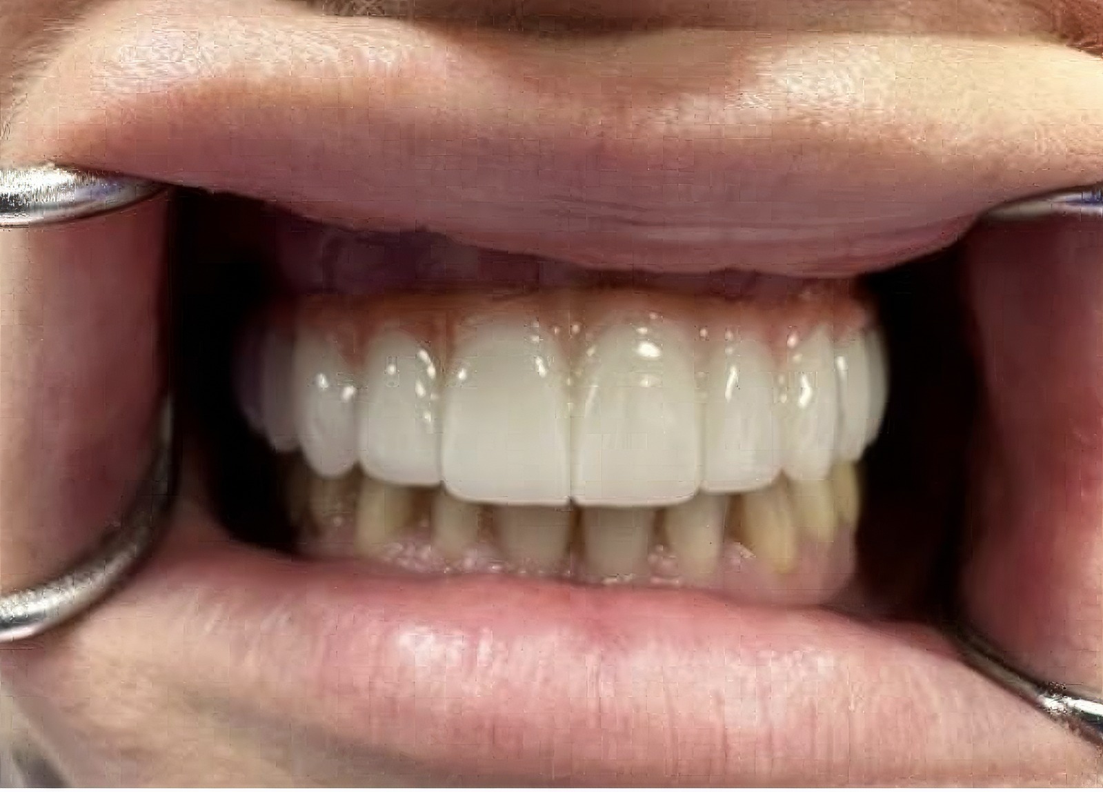 All-Digital Full Arch Restorations with ICam4D: Burbank Dental Lab Leads the Way  |  by Andrew Sedler