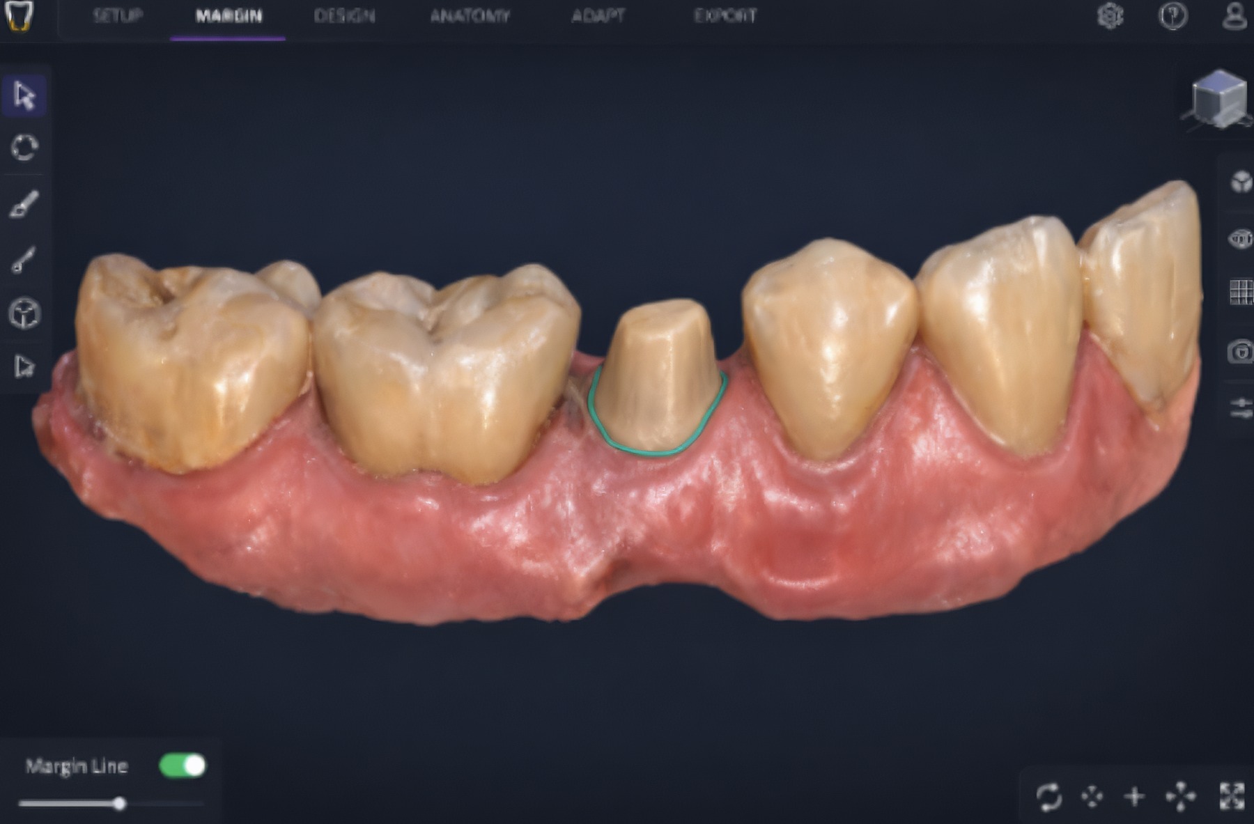How To Capture Accurate Crown Margins with An Intraoral Scanner  |  by Andrew Sedler  |  Burbank Dental Lab