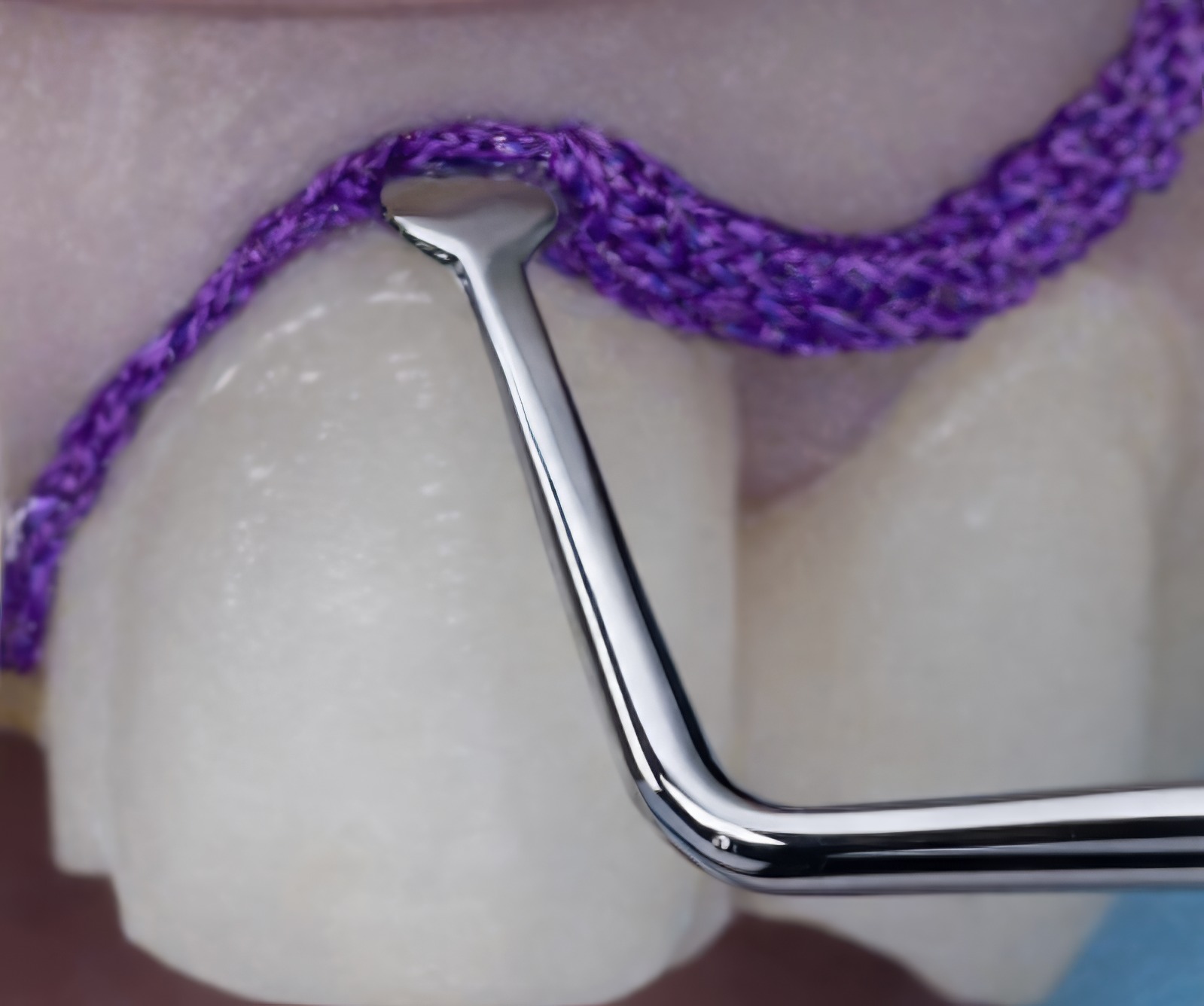 Step-By-Step Digital Workflow for Edentulous Implant Cases | Burbank Dental Lab